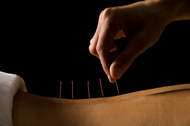 arthritis-acupuncture